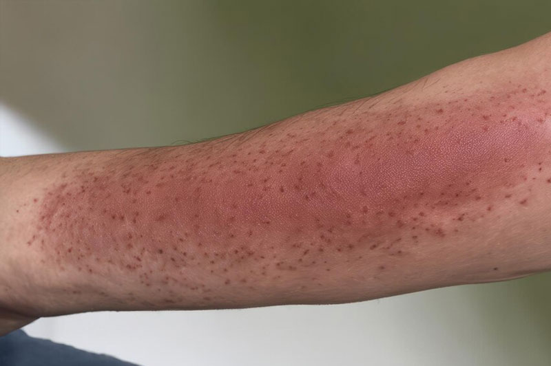 Dream about Blemish interpretation