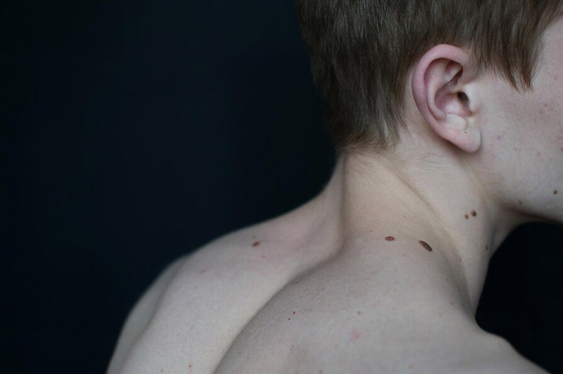 Dream about Blister interpretation