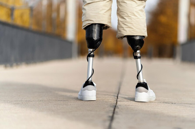 Dream about Amputation interpretation