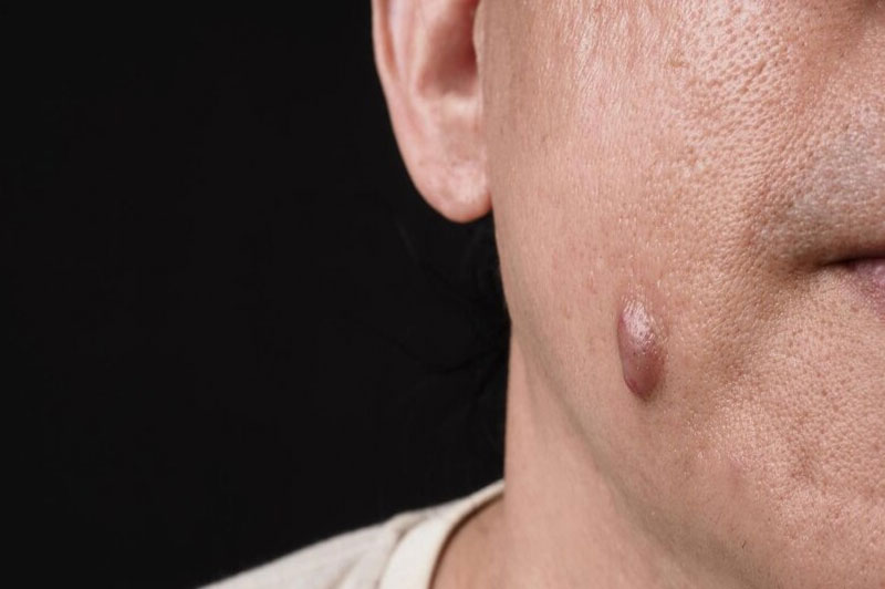 Dream about Carbuncle interpretation