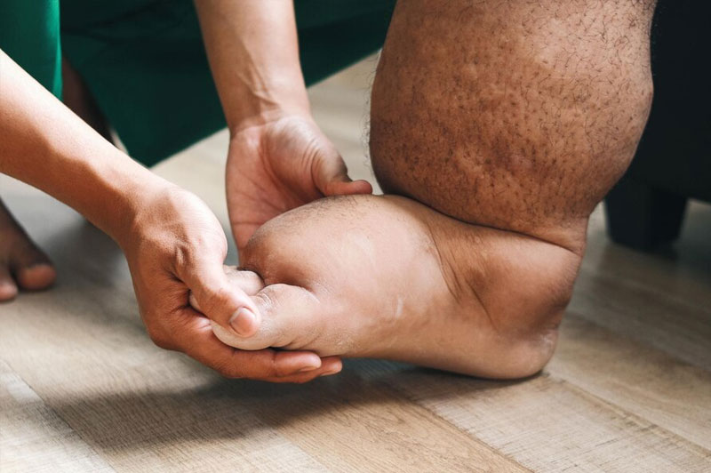 Dream about Chilblain interpretation