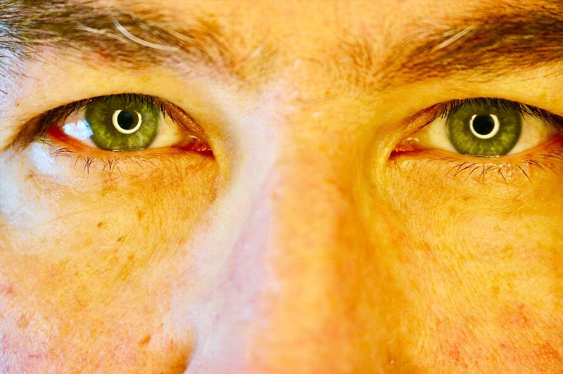 Dream about Jaundice interpretation