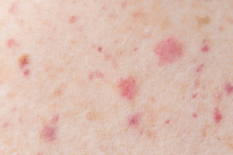 Dream about Small pox interpretation